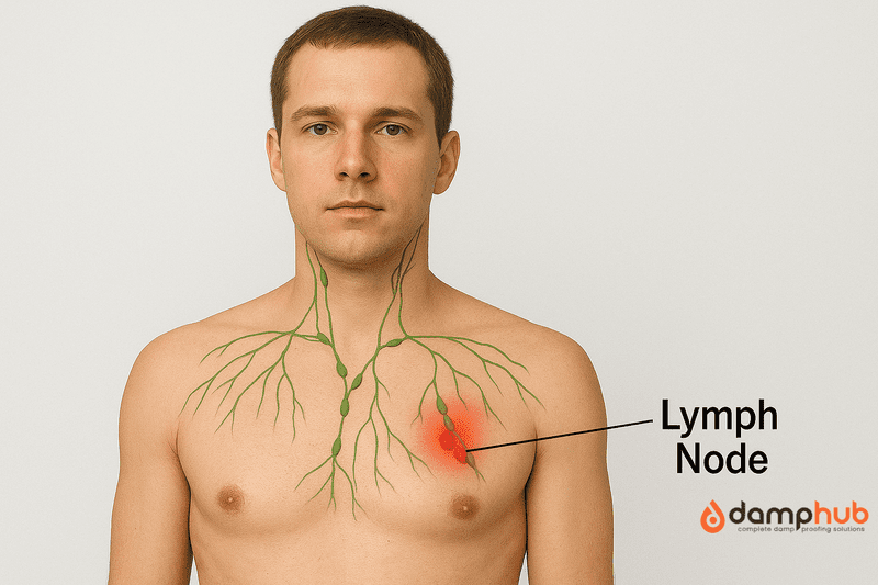 Medical illustration of a male upper body with natural skin tone, showing lymphatic pathways in green and swollen lymph nodes in red on the right chest. A black arrow labeled “Lymph Node” points directly at the inflamed nodes. Neutral light background.